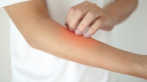 Black Seed Oil for Eczema: Evidence, Use and Caution